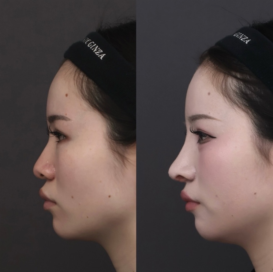 『【初回鼻整形】鼻を細く・高くするには骨から整える 骨切り幅寄せ×自家組織でつくる立体的で洗練された鼻』の画像