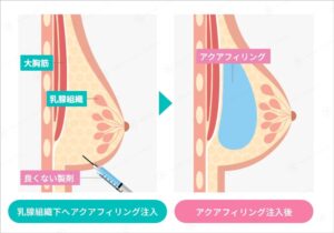 豊胸術による乳腺下へのアクアフィリング注入の断面図