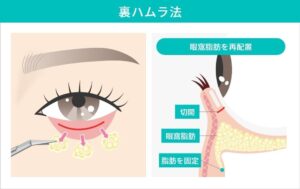 裏ハムラ法の施術と下眼瞼の解剖図