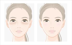 目の下のクマとたるみが改善した女性の比較