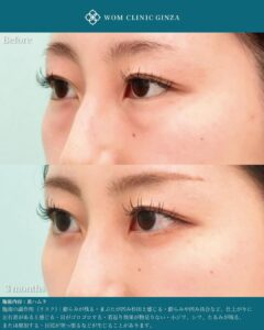 目元の施術前と3ヶ月後の比較