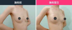 豊胸 術前と翌日の様子
