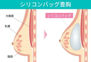 シリコンバッグ豊胸の前後を比較した乳房の断面図