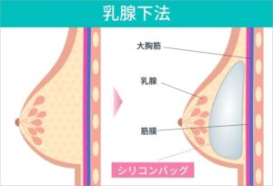 乳腺下法による豊胸手術の図解