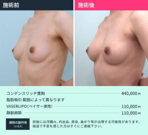 コンデスリッチ豊胸のビフォーアフター02