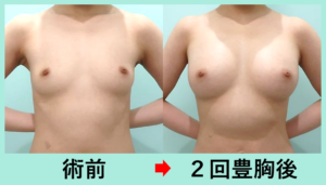 コンデスリッチ豊胸のビフォーアフター03