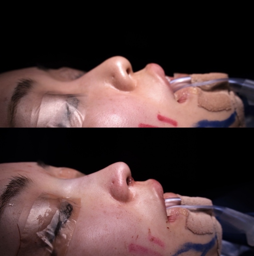 『【初回鼻整形】鼻を高くするだけでは足りない 中顔面の立体感で“顔全体のバランス”を整える鼻整形』の画像