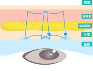 二重埋没法の糸を通す位置とまぶたの断面図