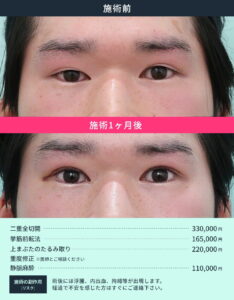 二重整形術前と術後1ヶ月の目の比較