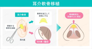 耳介軟骨移植による鼻形成術の図解