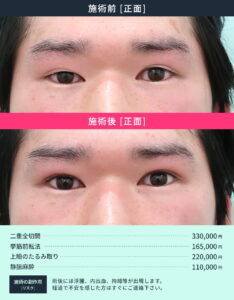 目元の後遺症治療のビフォーアフター