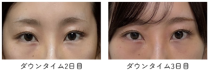 目元のダウンタイム比較 2日目と3日目