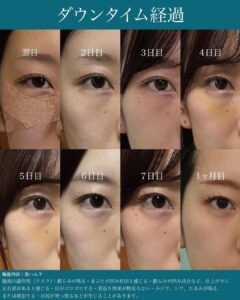 目元のダウンタイムの経過を時系列で示した画像