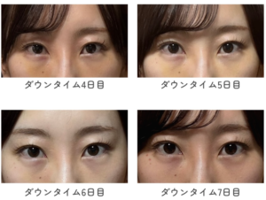 目元のダウンタイム経過写真4枚