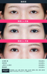目元整形の術前と施術1ヶ月後と3ヶ月後の目の比較