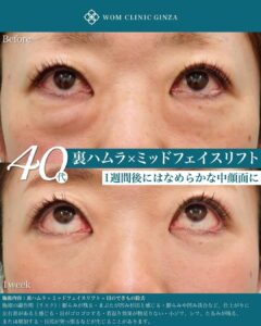 施術前後を比較する女性の目元アップ画像