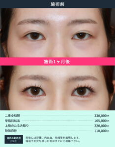目元整形の術前と施術1ヶ月後の比較