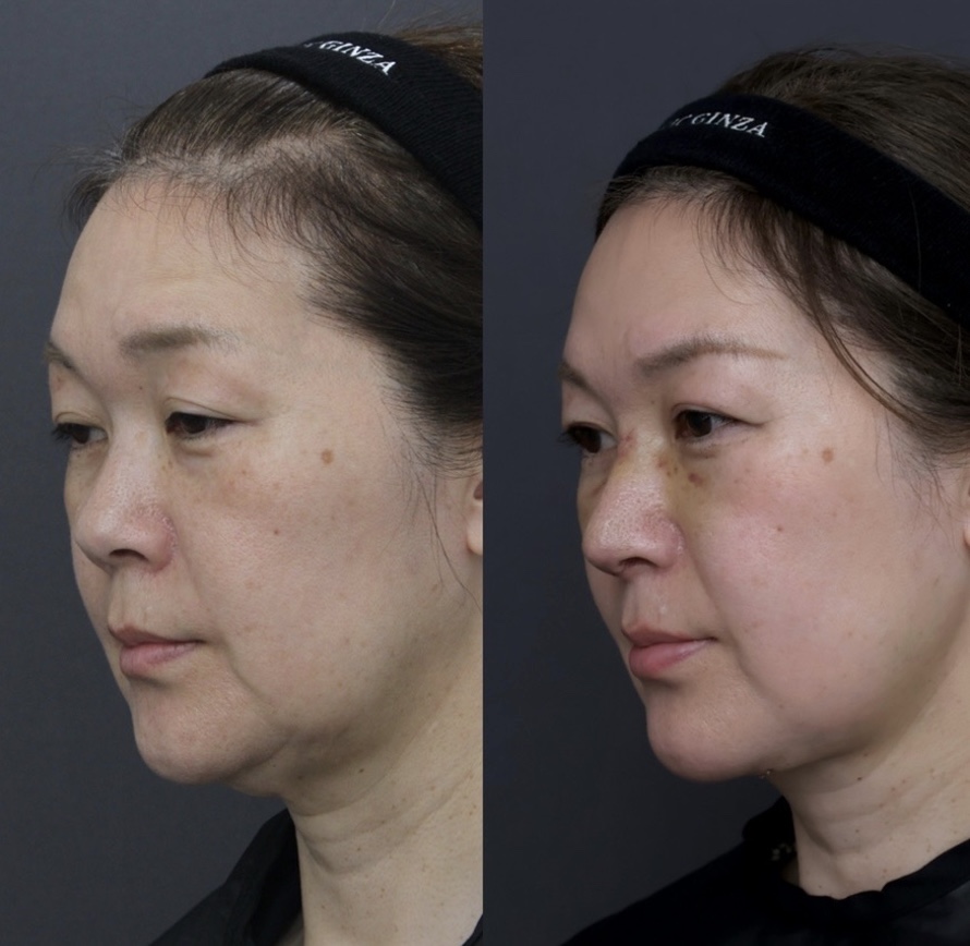 『【顎下のたるみ改善】ペリカン手術で根本から引き締める 脂肪吸引だけでは改善できない“本当のたるみ”とは』の画像