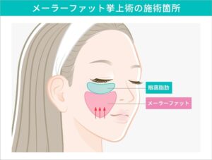 顔の頬と目の下の脂肪を示す図