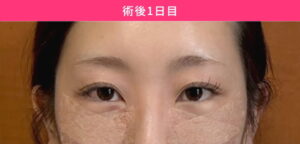 目元の施術後1日目の女性の顔