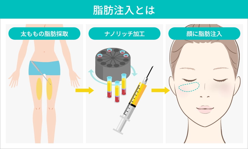 脂肪注入プロセスの図解