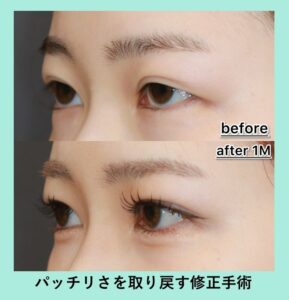 施術前後比較女性の目元アップ