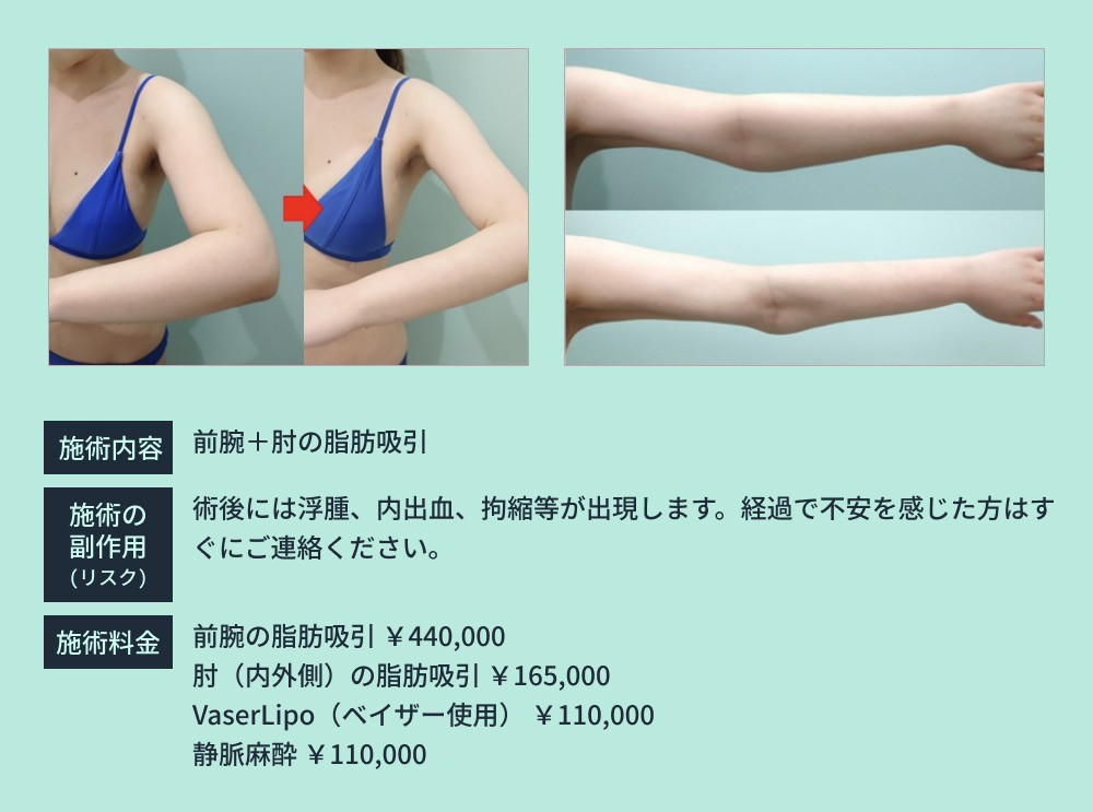 前腕の脂肪吸引のビフォーアフター