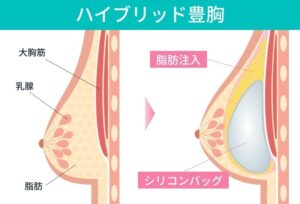 ハイブリッド豊胸手術の前後比較図