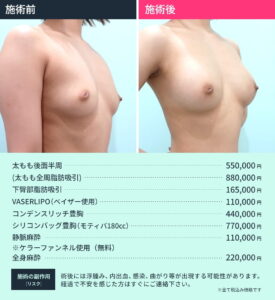 ハイブリッド豊胸のビフォーアフター