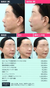 切開リフト後のビフォーアフター01