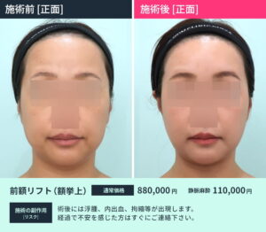 切開リフト後のビフォーアフター02