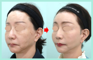 切開リフトのビフォーアフター詳細