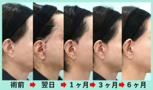 切開リフト術前から完成までのダウンタイム経過