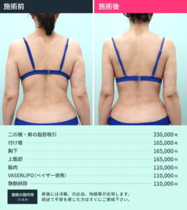 脂肪吸引修正のビフォーアフター