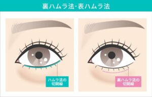下まぶたのハムラ法における切開線の比較