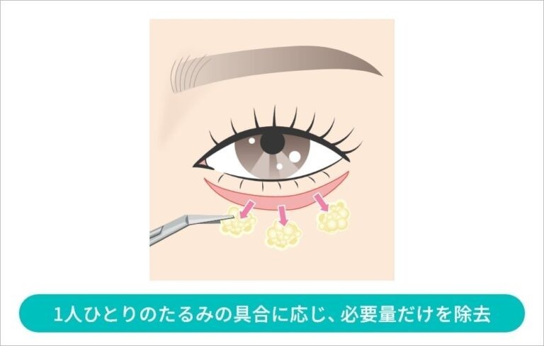 下まぶたから脂肪を除去するイラスト