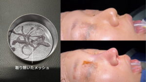 摘出された鼻のメッシュと術前後の鼻