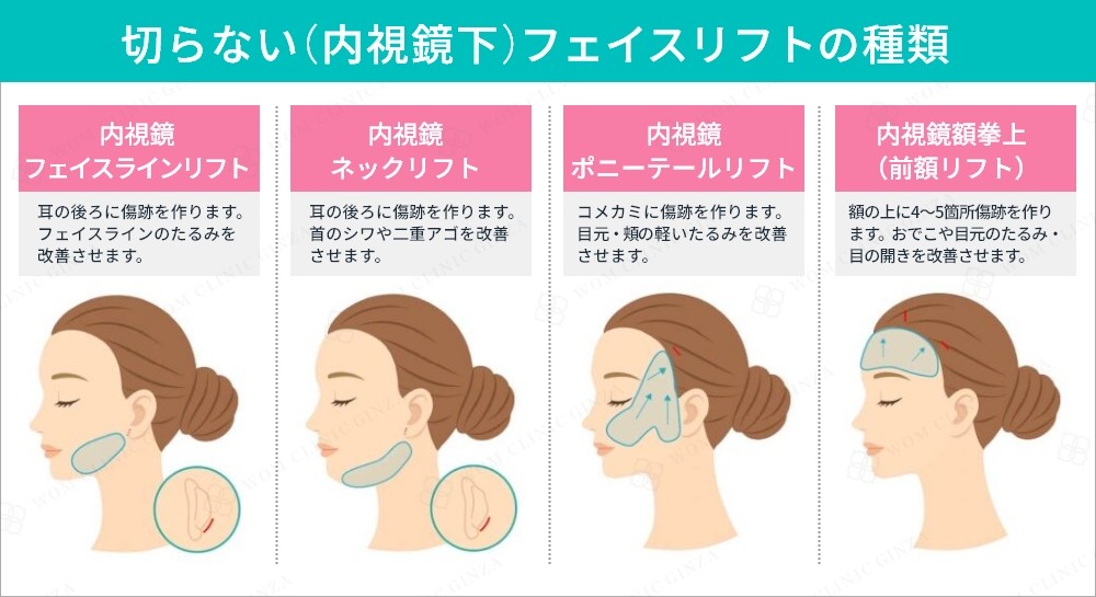 切らないフェイスリフト4種類の施術部位比較