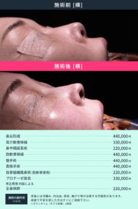 鼻の後遺症治療のビフォーアフター01