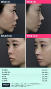 鼻の後遺症治療のビフォーアフター03