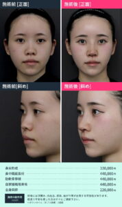 鼻整形のビフォーアフター01