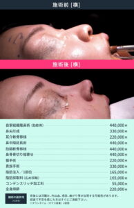 鼻整形のビフォーアフター02