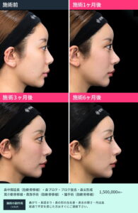 女性の鼻の美容整形術前1ヶ月3ヶ月6ヶ月後の変化