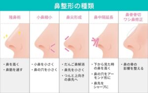 鼻整形の種類と施術内容を解説する図