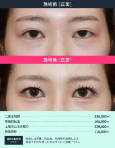 目元整形修正のビフォーアフター1