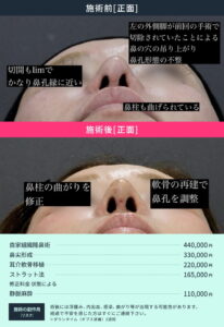 鼻整形修正のビフォーアフター01