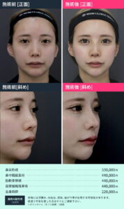 鼻整形修正のビフォーアフター02
