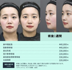 鼻整形修正のビフォーアフター03