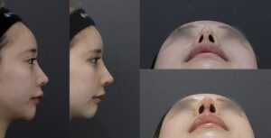 鼻整形修正のビフォーアフター04