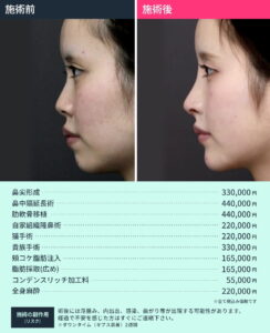 鼻整形のビフォーアフターと料金詳細01